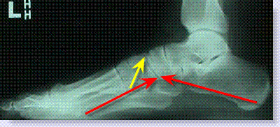 x-ray of normal midtarsal area