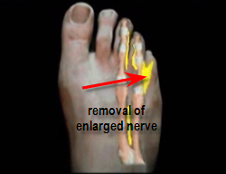 excision of morton's neuroma