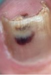 melanoma of nail