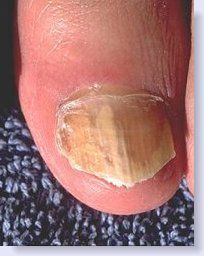 fungus toe nail