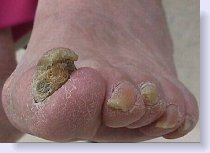 severe_nail_fungus