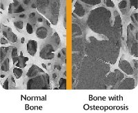 osteoporosis picture