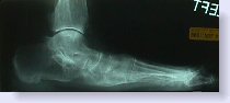 osteoporosis foot x-ray