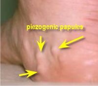 piezogenic papules in foot