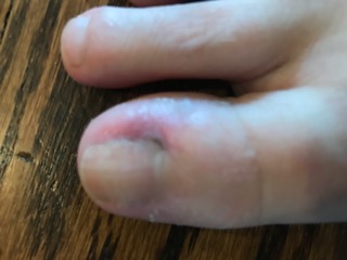 infected ingrown nail?