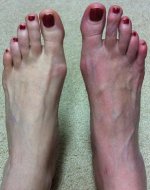normal foot vs. crps foot