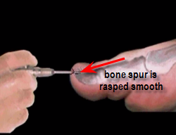 section of bone to be removed in subungual exostosis