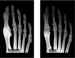 before and after Swanson total implant