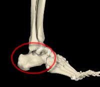 tarsal_coalition