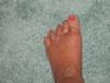 5 months post op for Mortons neuroma