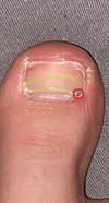 Right big toenail w the dot and outline