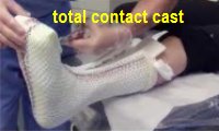 total contact cast