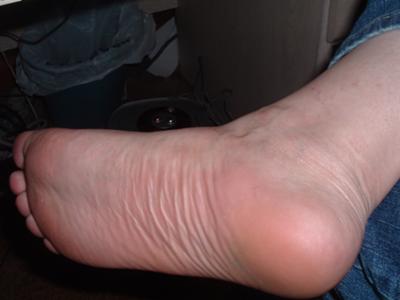 Foot pain pressure @ heel/arch