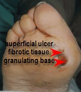 ulcer with granulating and fibrotic base